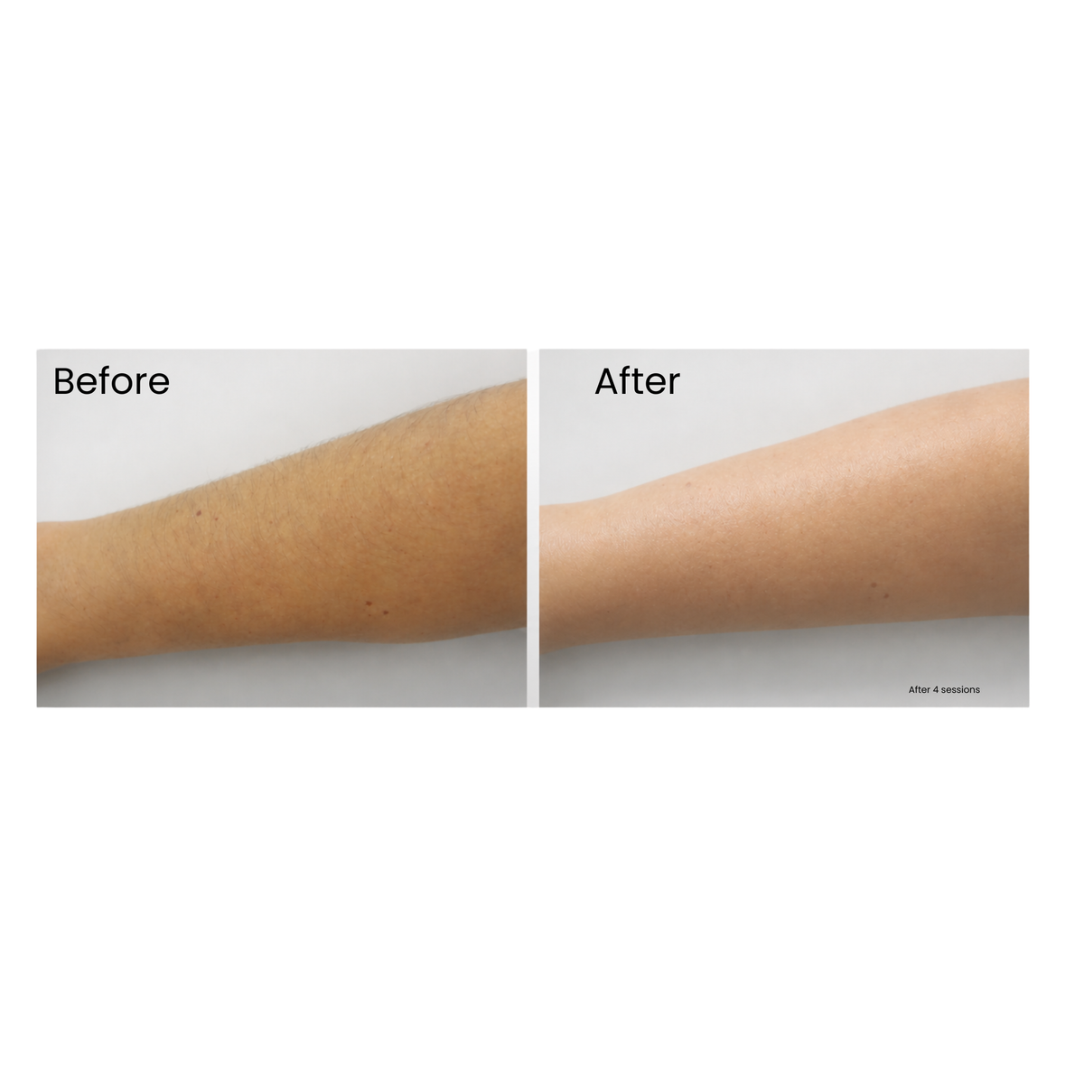 Sensilight™ Pro At-Home Cordless IPL Hair Removal