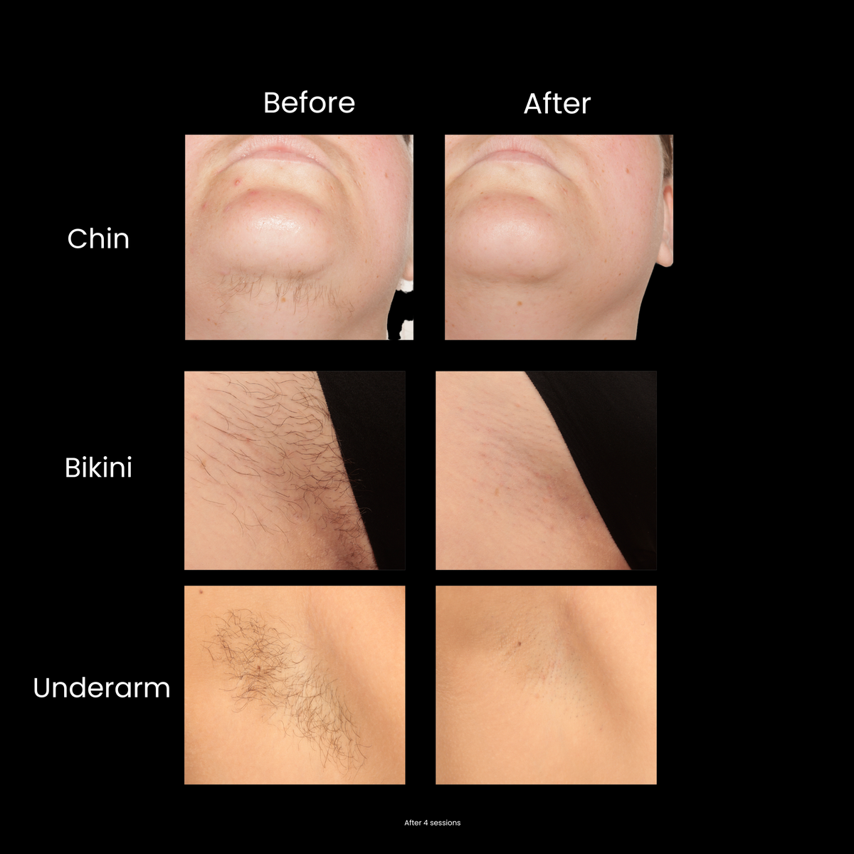Sensilight™ ICE Cooled IPL Hair Removal
